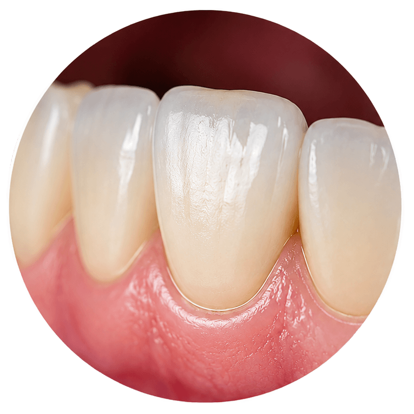 What is a dental crown - tooth protective cover